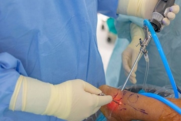 Arthroscopy Surgery Dubai