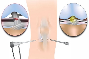 Arthroscopy Surgery in Dubai