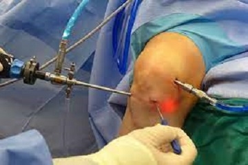 Arthroscopy Surgery In Jamshedpur