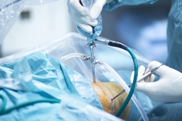 Arthroscopy Surgery In Nepal