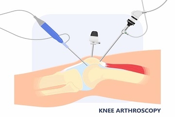 Arthroscopy Surgery  Kenya